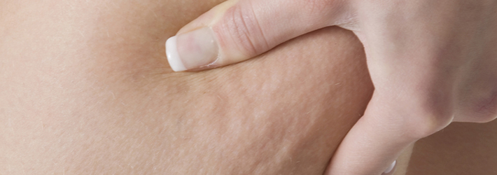 Zur Behandlung von hartnäckiger Cellulite setzt die Rosenpark Klinik das derzeit effektivste Verfahren ein: die Laserlipolyse. Zur Behandlung von hartnäckiger Cellulite setzt die Rosenpark Klinik das derzeit effektivste Verfahren ein: die Laserlipolyse.