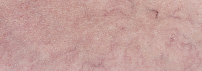 Couperose, das sind feinen &Auml;derchen, die bl&auml;ulich-rot durch die Gesichtshaut schimmern. Eine typgerechte Therapie in der Rosenpark Klinik hilft, die Symptome deutlich zu lindern.