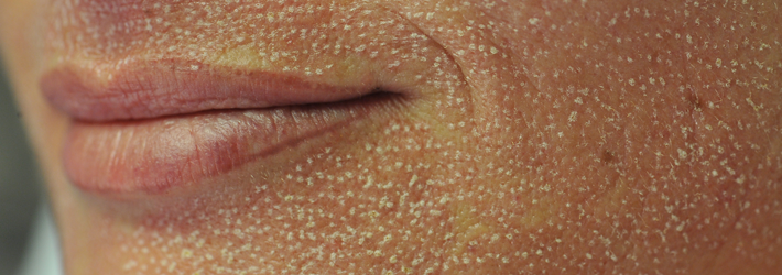 Nachherbild der Mnundpartie einer Laserbehandlung zur Gesichtsverj&uuml;ngung